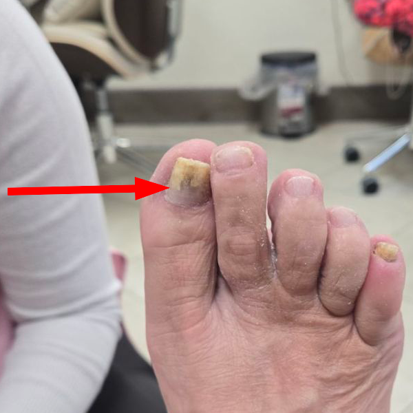 Toenail fungus elimination and grow-out by Healthy Naturally You