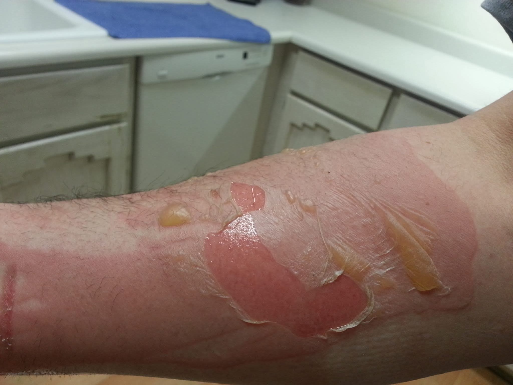 Burn Healing Treatment Process and Progression by Healthy Naturally You