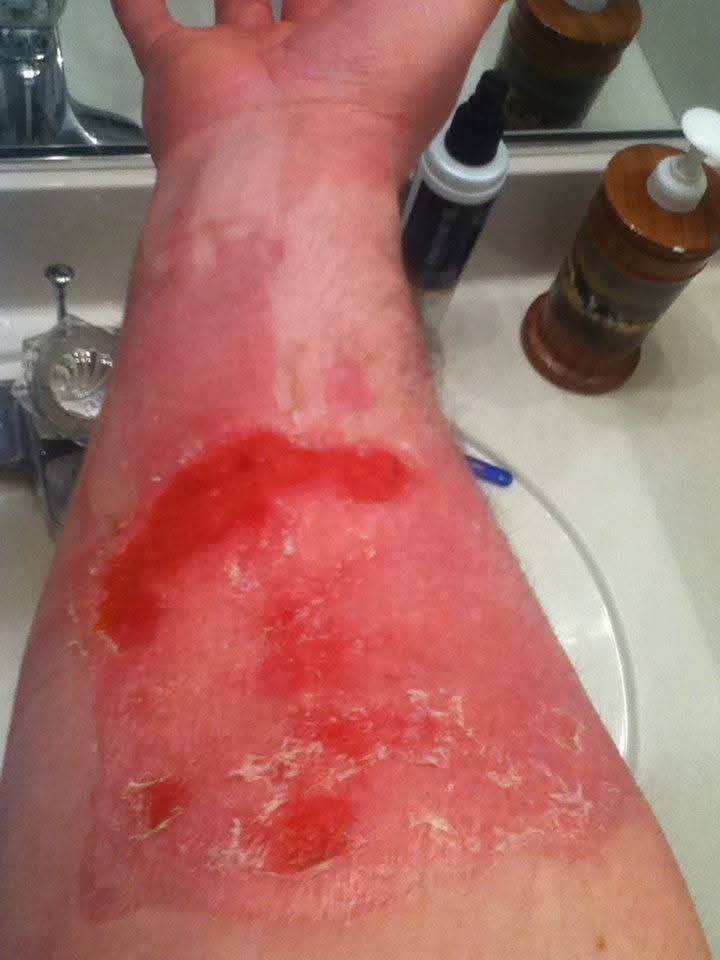 Burn Healing Treatment Process and Progression by Healthy Naturally You