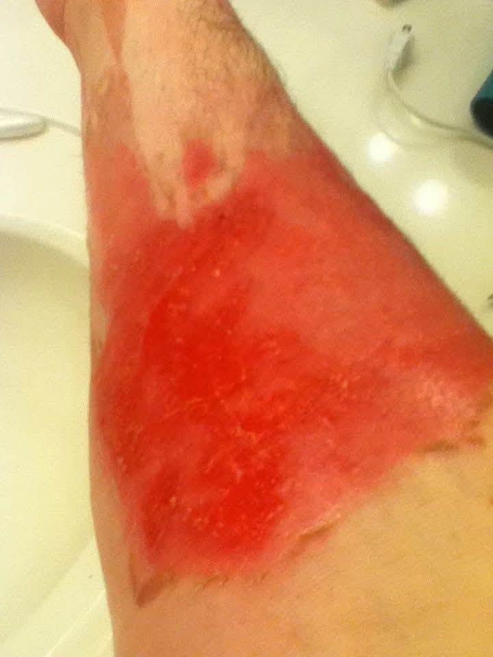 Burn Healing Treatment Process and Progression by Healthy Naturally You