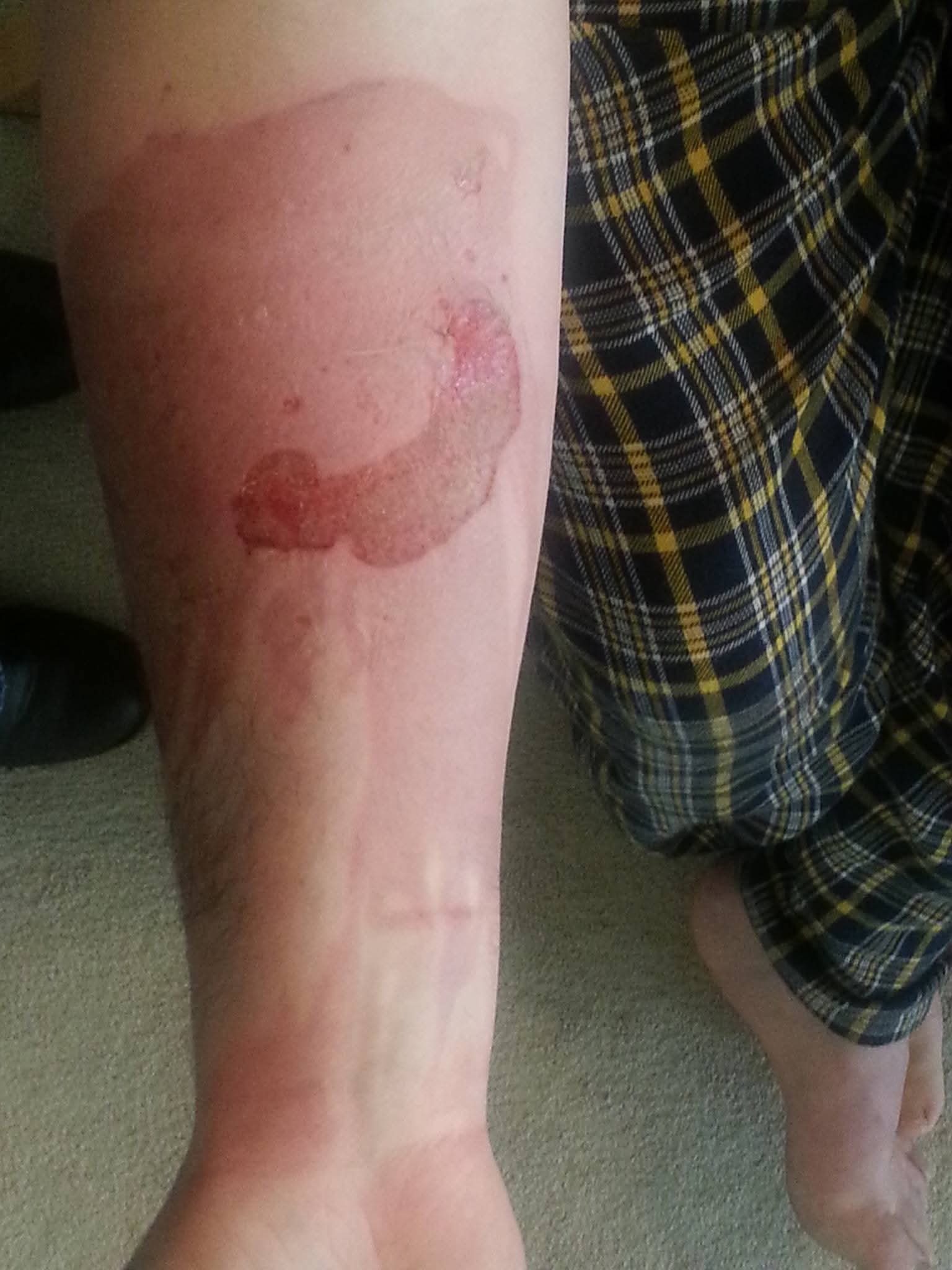 Burn Healing Treatment Process and Progression by Healthy Naturally You