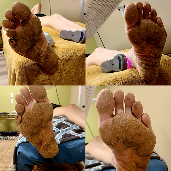 Foot skin and tissue regeneration therapy in Oro Valley, AZ