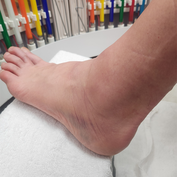 Sprained ankle and sports injury treatment by Health Naturally You in Oro Valley, AZ