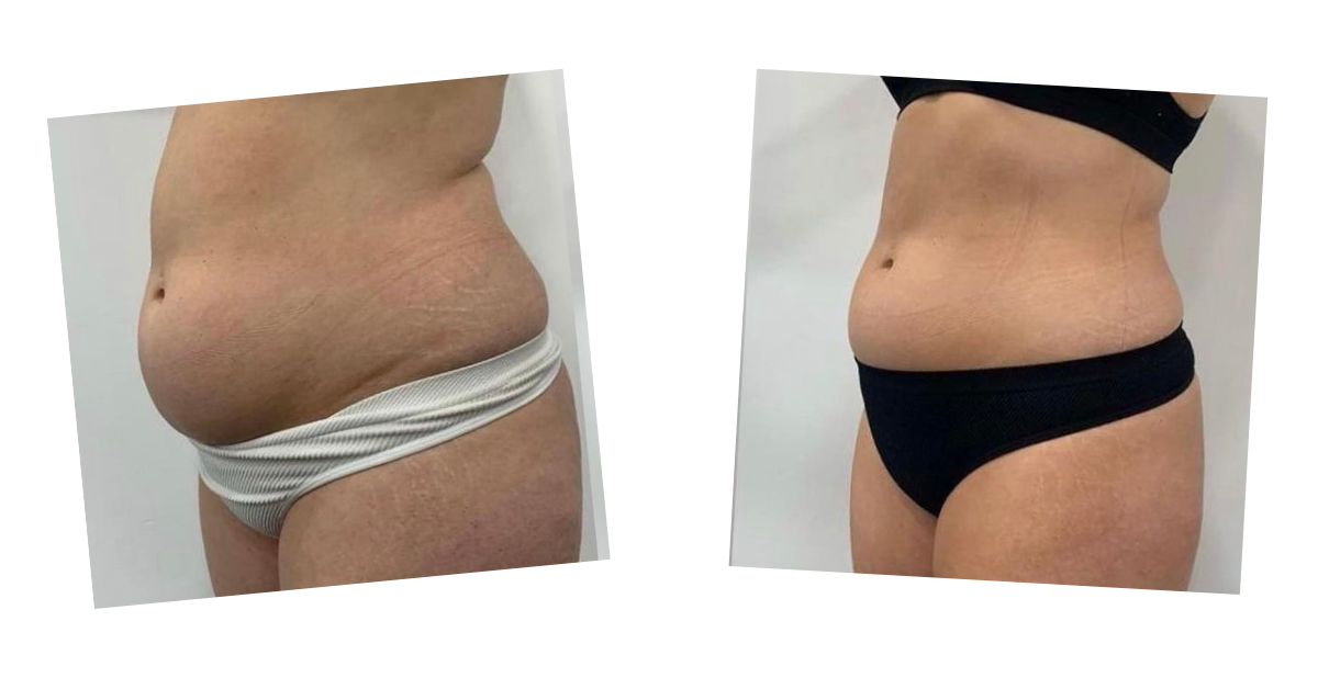 Erchonia Laser Weight Loss Treatment examples by Healthy Naturally You in Oro Valley, AZ