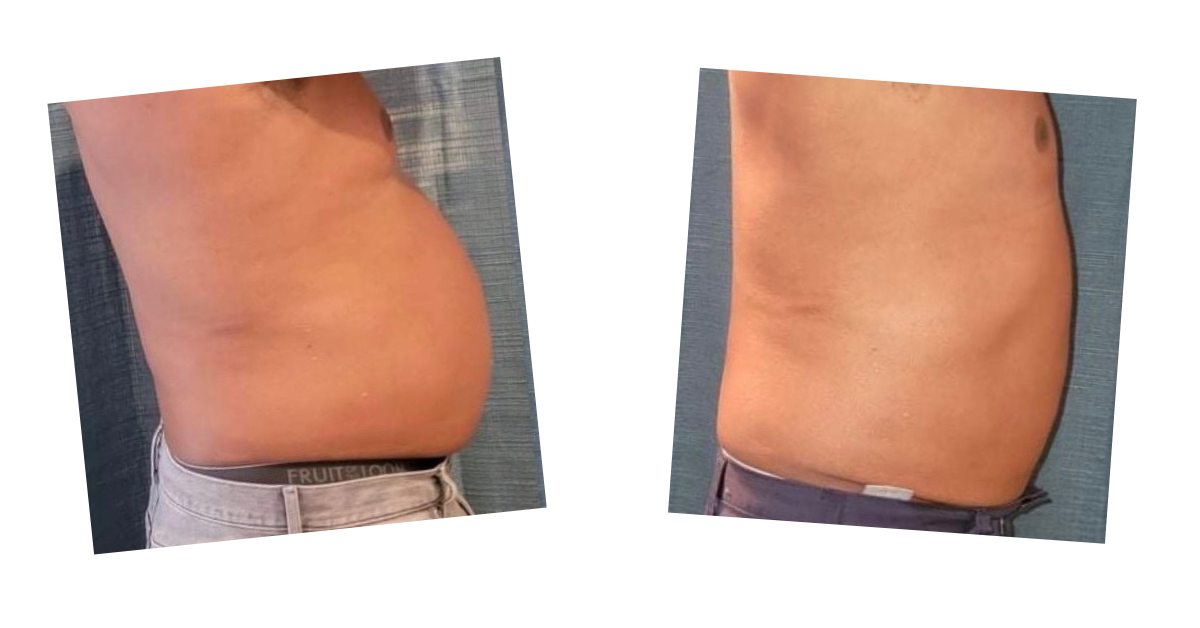 Erchonia Laser Weight Loss Treatment examples by Healthy Naturally You in Oro Valley, AZ