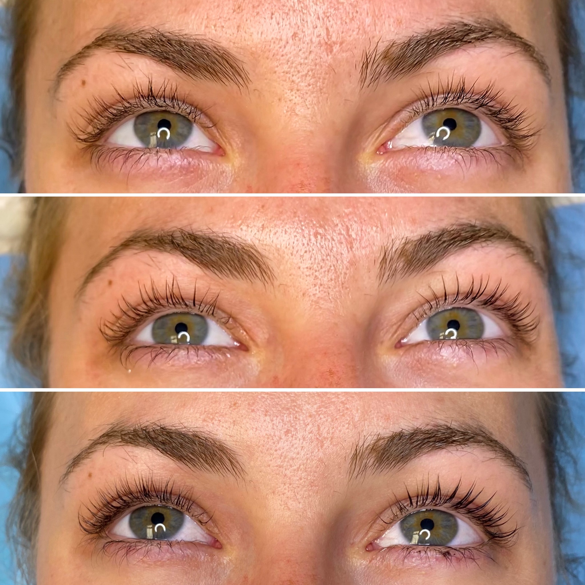 image of herbal acupuncture setup