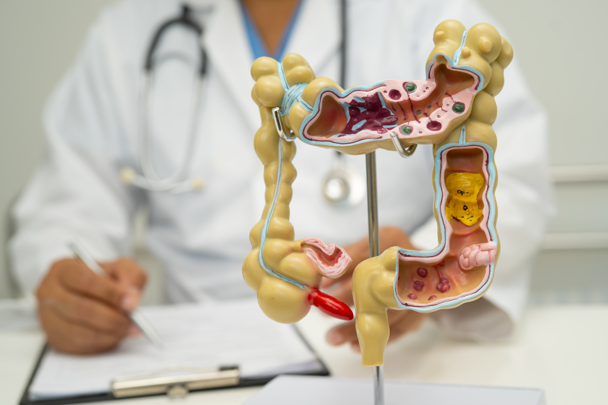 Colorectal Cancer