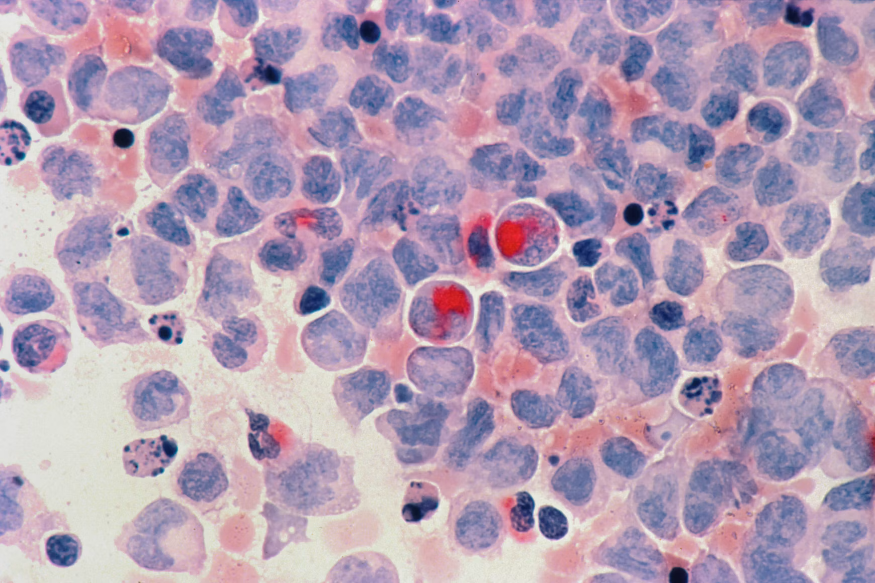 Acute Leukemia