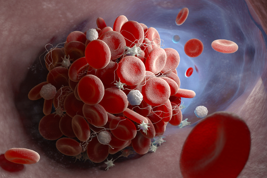 DVT and Pulmonary Embolism