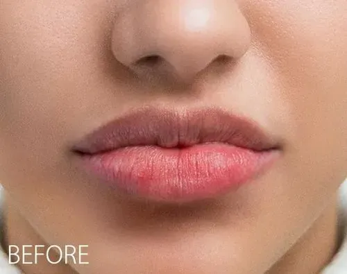This specialized semi-permanent treatment is designed for clients with uneven lip color, pigmentation or unwanted darker areas. It focuses on color correcting and neutralizing the darker areas of the lips before applying a custom-blended pigment to achieve brighter, more even-toned lips. This is a two-appointment process, with a follow-up recommended 4-12 weeks after the initial session to assess healing and refine the results as needed.