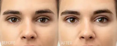 تعبئة الحواجب شعرة بشعرة بتقنية براو هي أحد أشكال المايكروبليدنج، وهي مصممة لملء الفراغات الموجودة في الحاجبين، حيث يتم إضافة شعيرات مشابهة لشعر الحاجب الطبيعي في الفراغات وتمتزج مع شعر الحاجب لتمنحكِ في النهاية مظهرًا مثاليًا وحواجب أنيقة.
تُتبع الجلسة الرئيسية بجلسة رتوش، والتي تكون عادةً بعد 4 إلى 12 أسبوعًا، وذلك لتقييم النتائج وتحسينها حسب الحاجة.