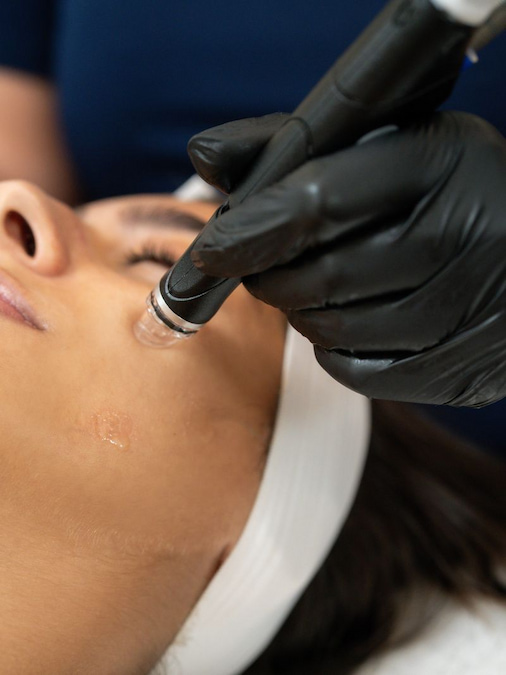 Microneedling collagen stimulation