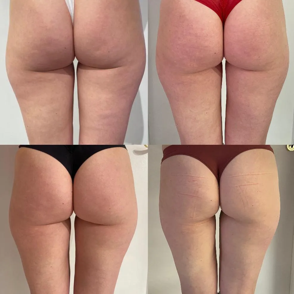 endermologia-uda-posladki-przed-po-klinika-wowme-torun
