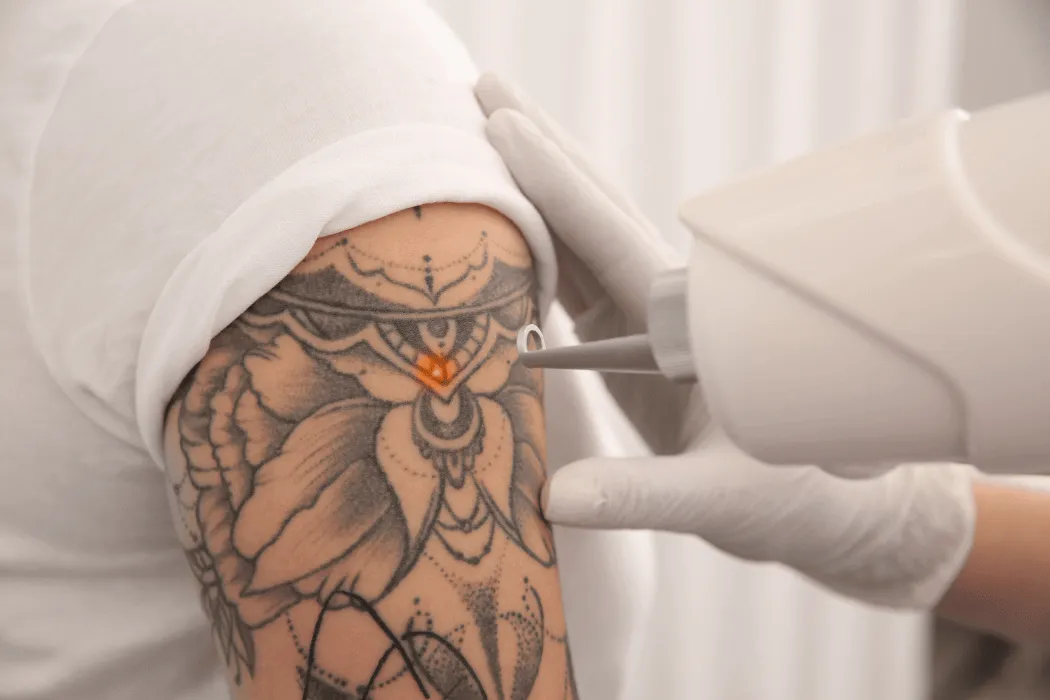 wowme-torun-laserowe-usuwanie-tatuazu-zabieg-skory