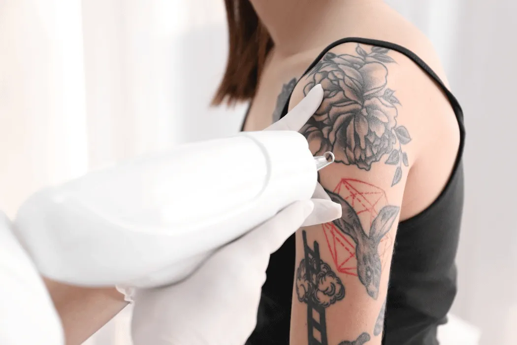 laserowe-usuwanie-tatuazu-wowme-torun-gabinet-estetyczny