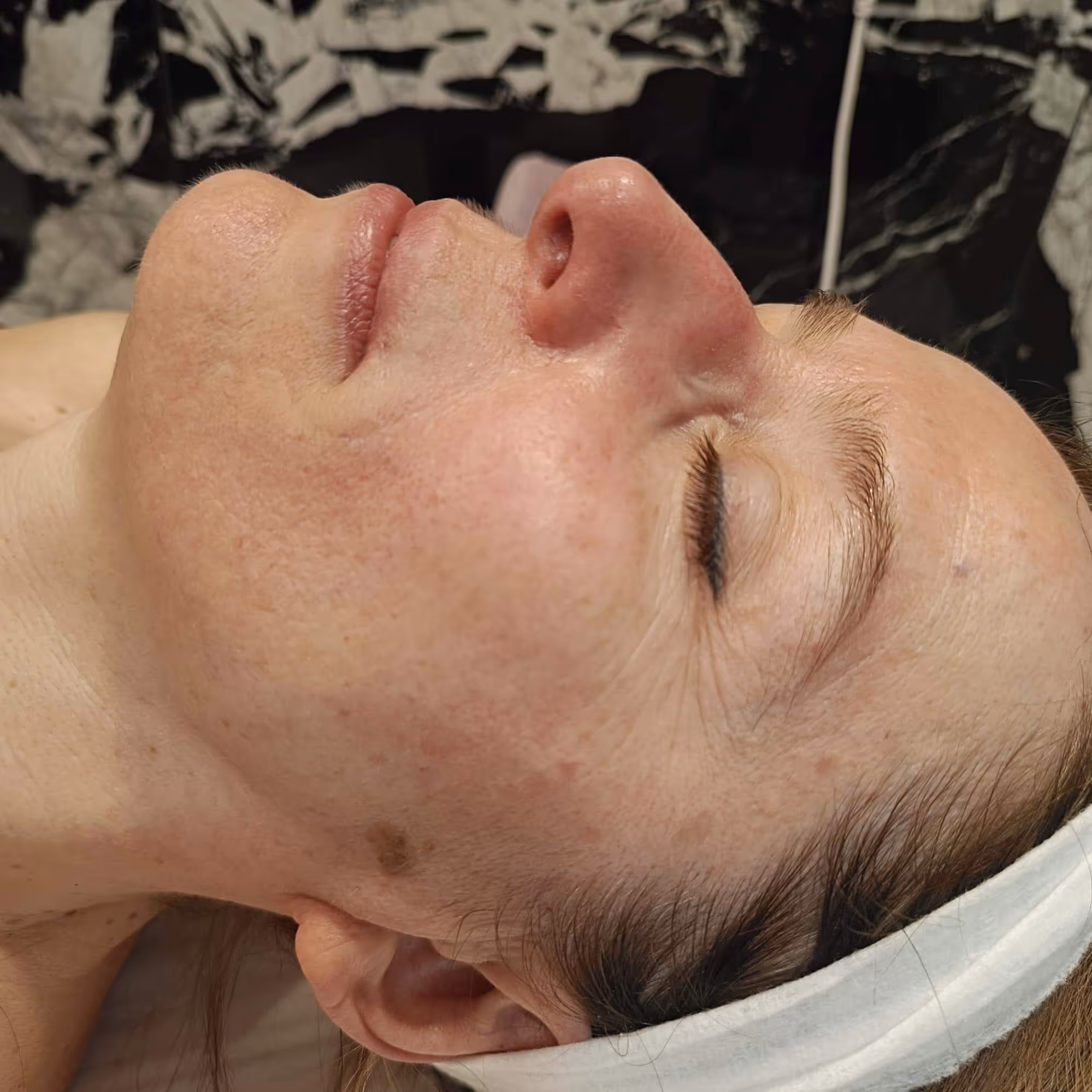 Zbliżenie na skórę twarzy przed zabiegiem laseroterapii głowicą DVL
