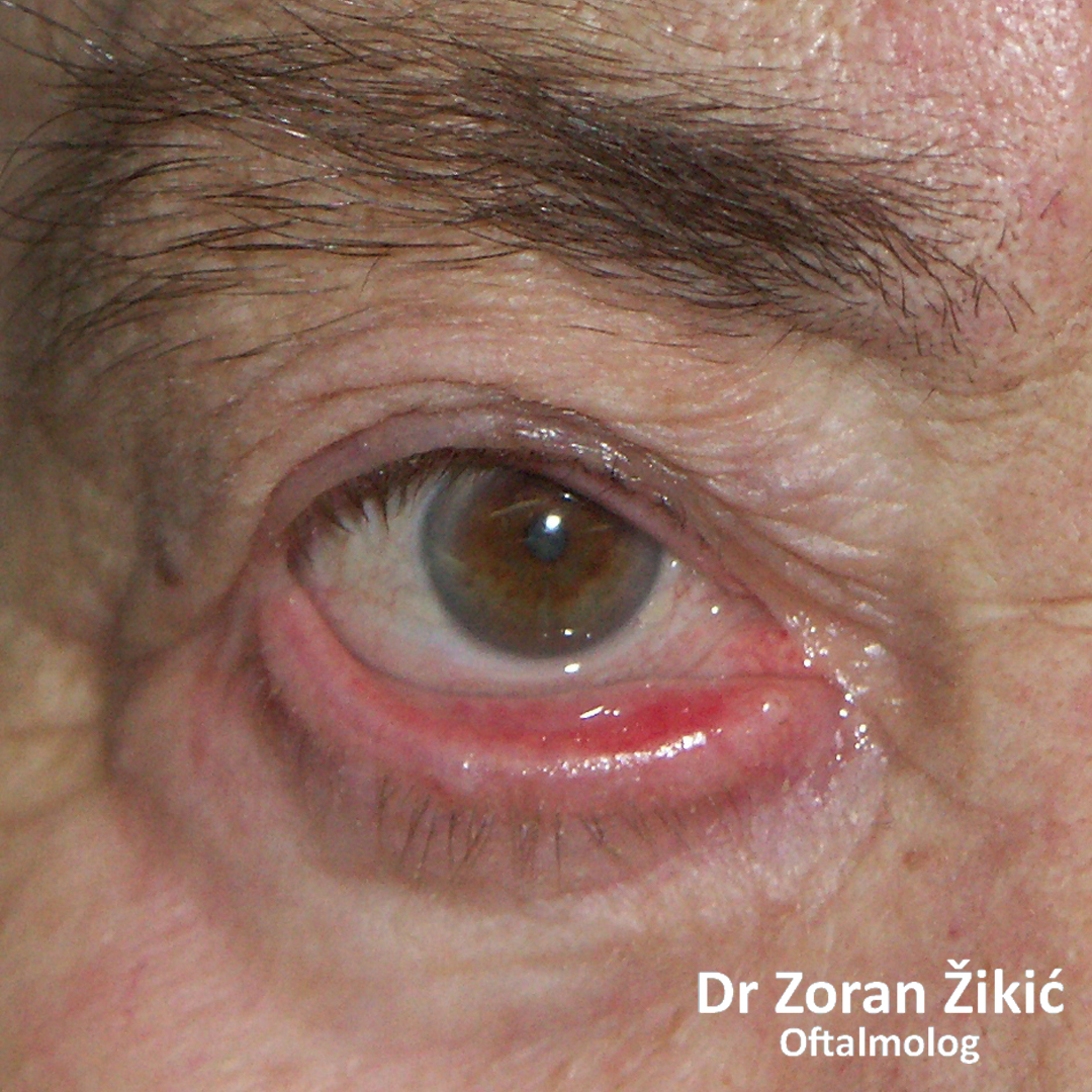 Ektropion unutrašnjeg dela donjeg kapka