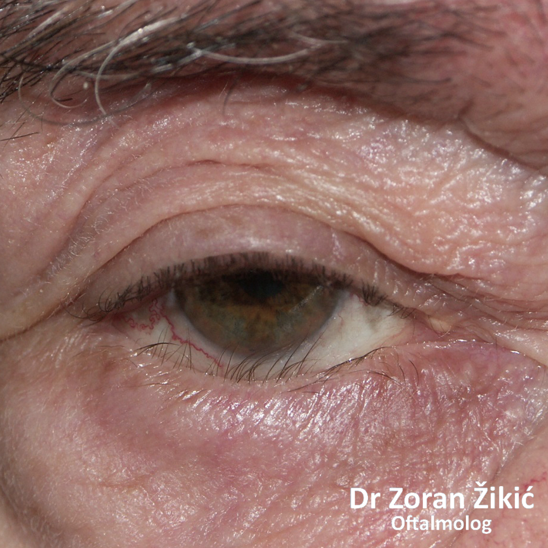 Entropion donjeg kapka, sa posledičnim uvrtanjem trepavica prema oku