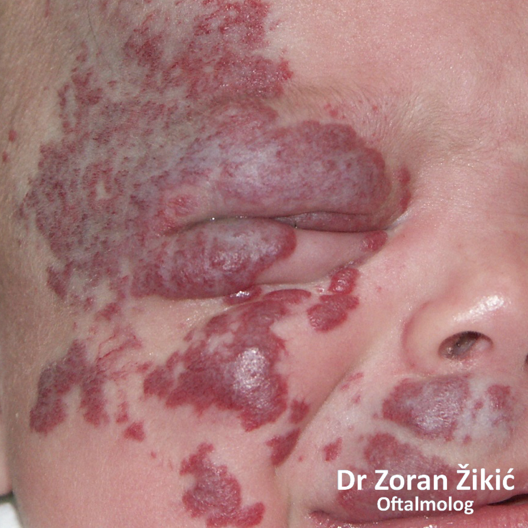 Hemangiom desne strane lica kod odojčeta.