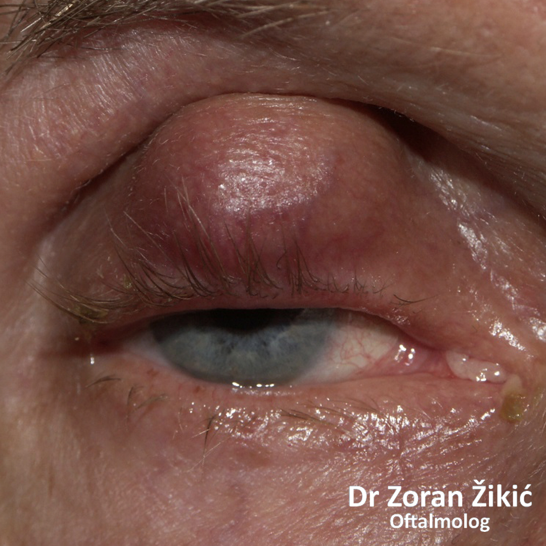 Velika cista (dobroćudna promena) gornjeg kapka