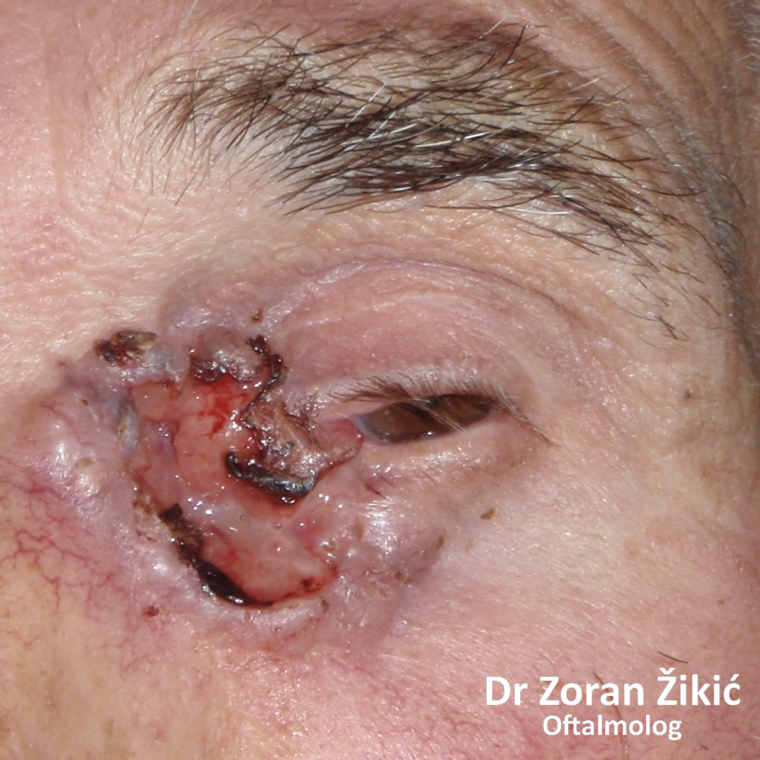 Zloćudni tumor unutrašnjeg ugla kapaka, u poodmaklom stadijumu