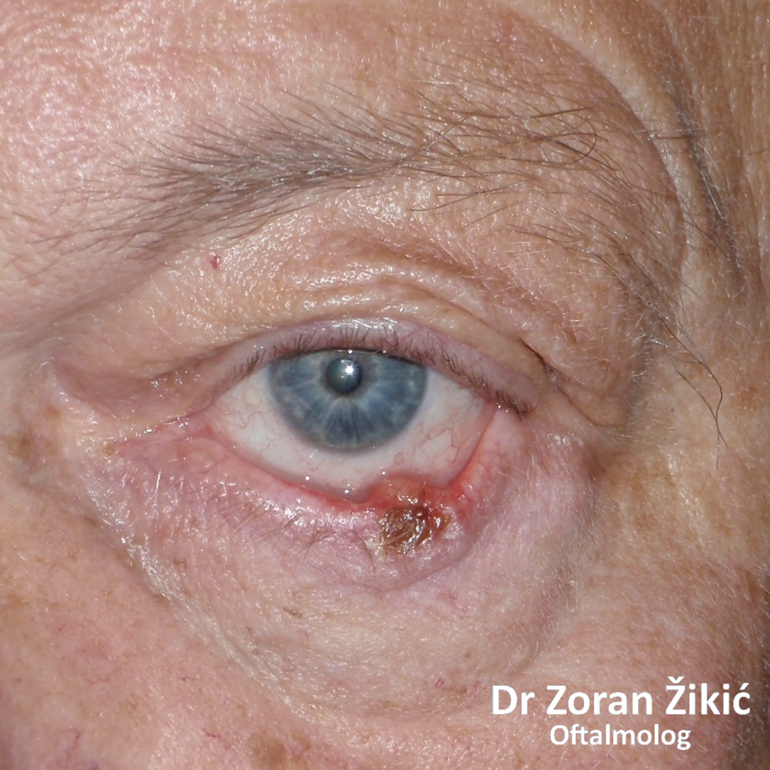 Zloćudni tumor donjeg kapka