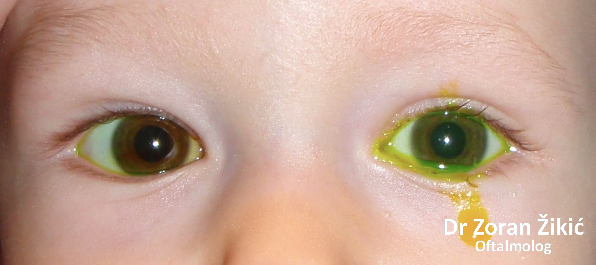 Ektropion unutrašnjeg dela donjeg kapka