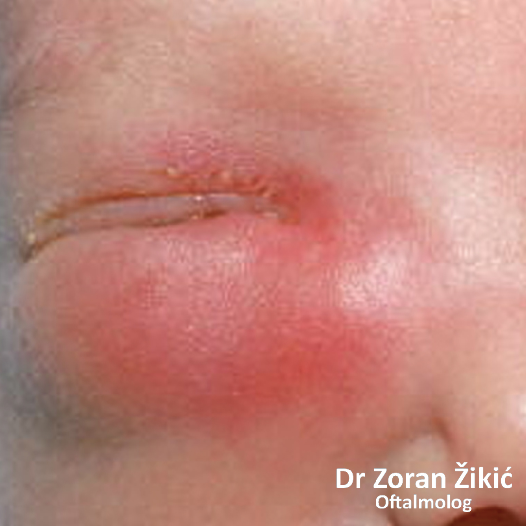 Entropion donjeg kapka, sa posledičnim uvrtanjem trepavica prema oku