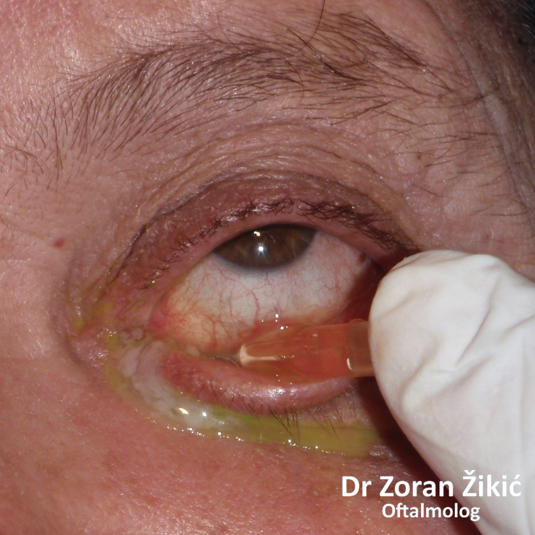 Zloćudni tumor unutrašnjeg ugla kapaka, u poodmaklom stadijumu
