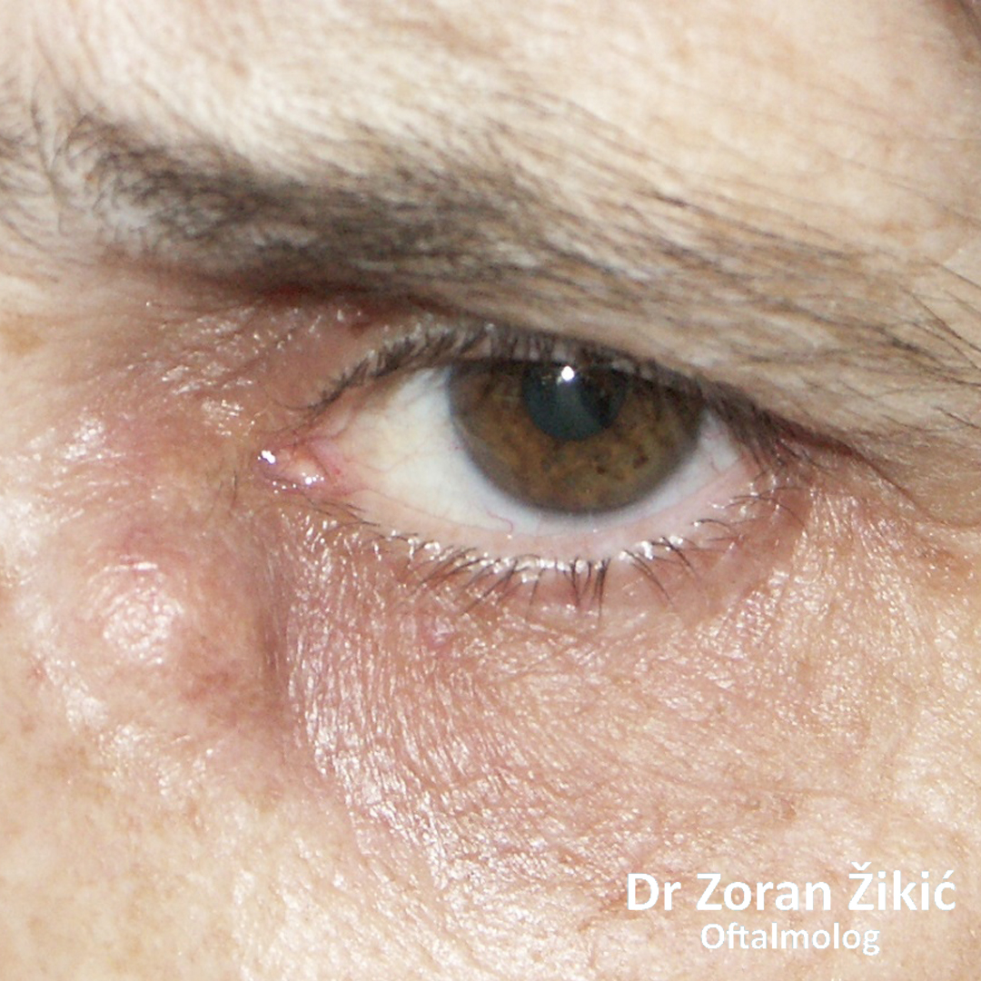 Zloćudni tumor donjeg kapka