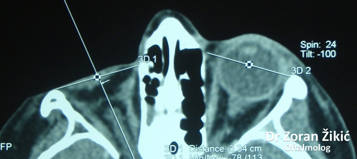 Zloćudni tumor unutrašnjeg ugla kapaka, u poodmaklom stadijumu
