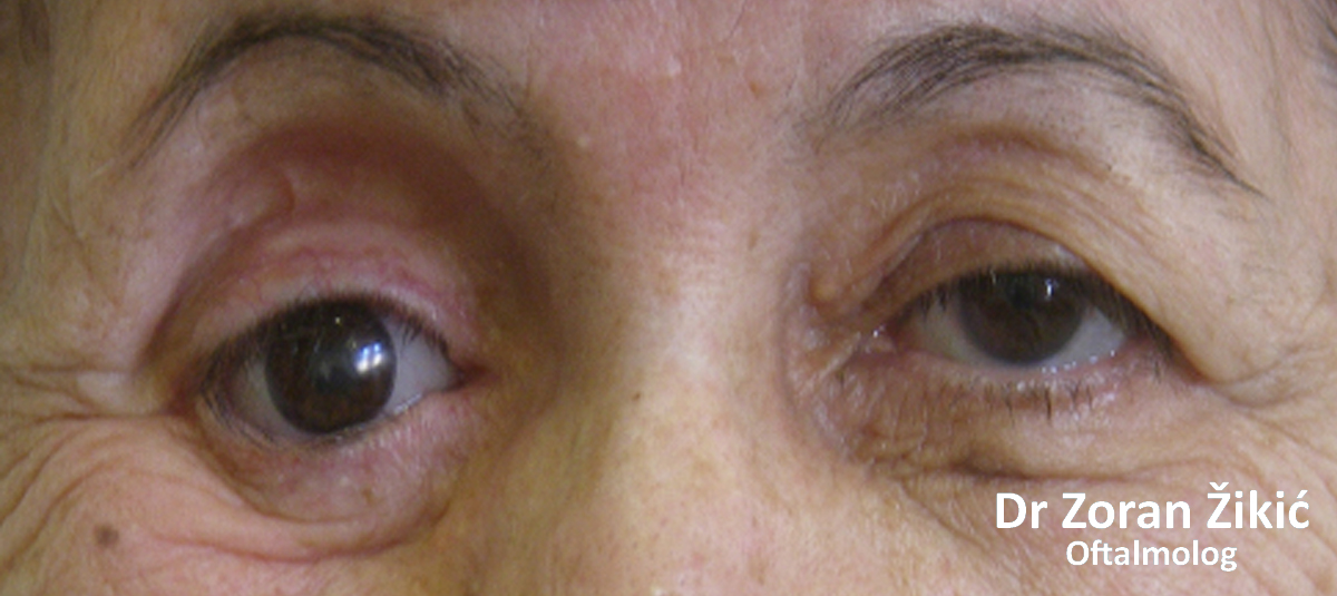 Zloćudni tumor donjeg kapka