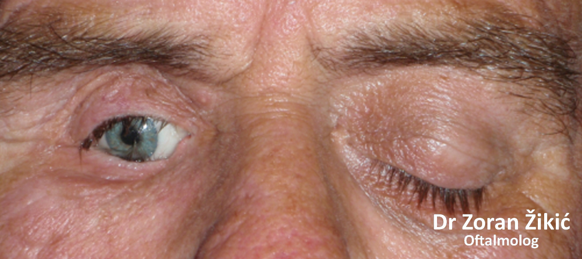 Zloćudni tumor donjeg kapka