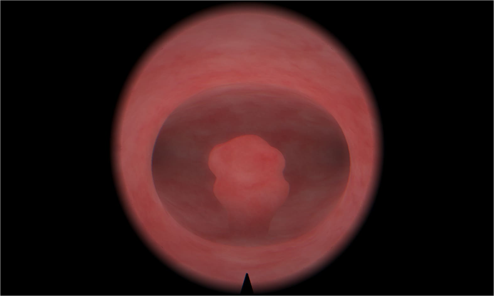 Visualization of a polypectomy using a HystVision device
