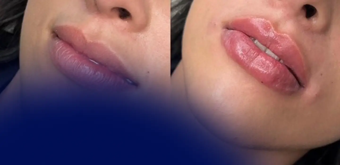 Latin Lips - Lip Filler Technique on the Rise