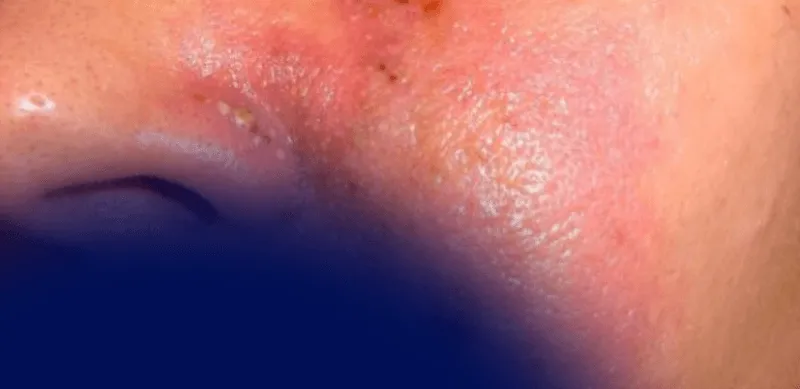Signs of Vascular Occlusion After Filler and How to Respond