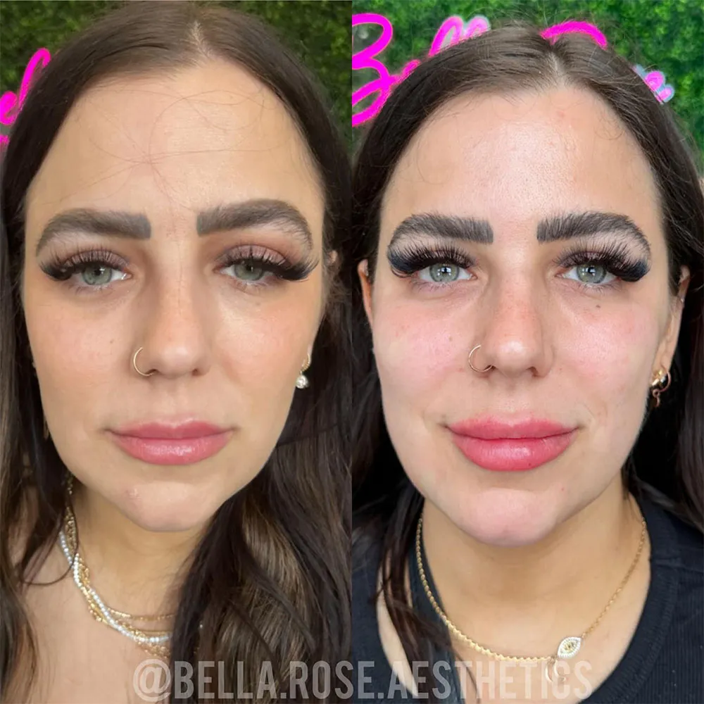 skin tightening with Biostimulatory Injectables