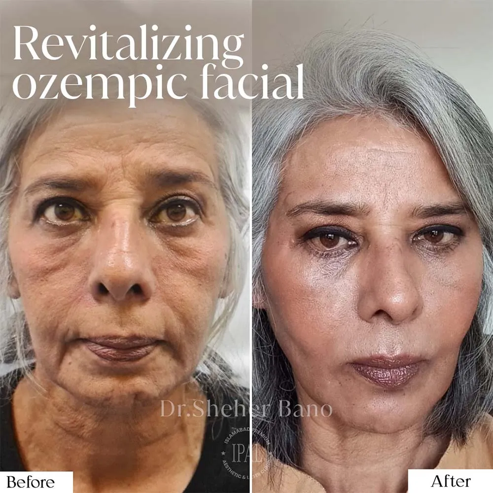 Ozempic Face Before And After Celebrities 60 Photos Moonagedaydream film Ozempic Face Before And After Celebrities 60 Photos Moonagedaydream film