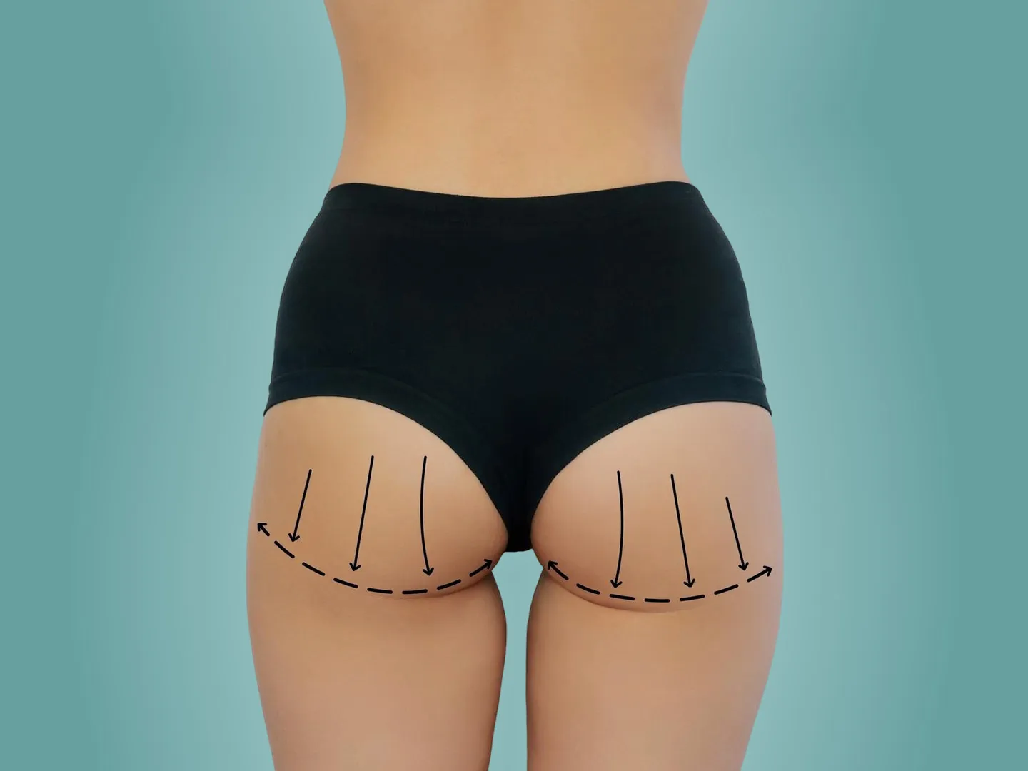 Sculptra for Buttocks Before and After Butt Lift Results