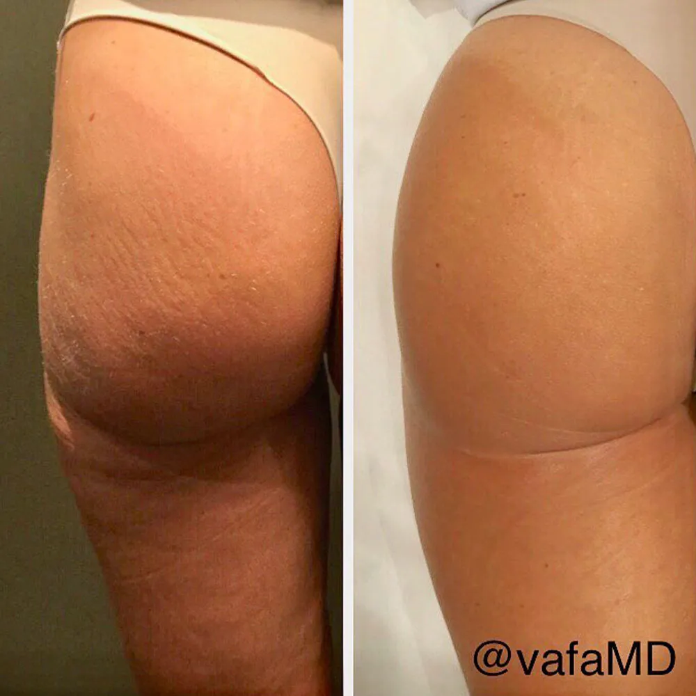 Sculptra for Buttocks Before and After - Non-Surgical BBL Results