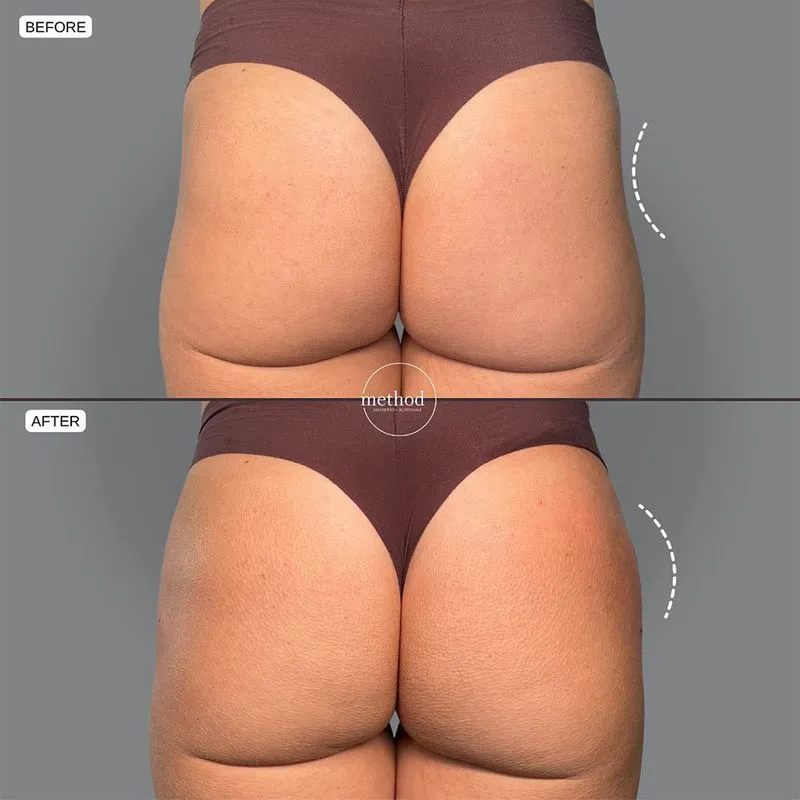 Sculptra for Buttocks Before and After - Non-Surgical BBL Results