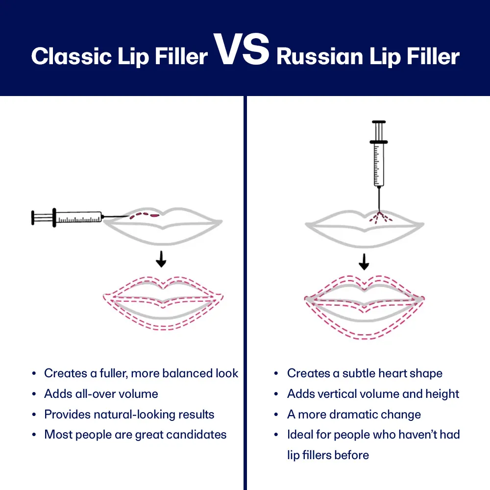russian lip filler technique