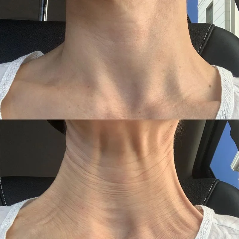 botox for neck before and after