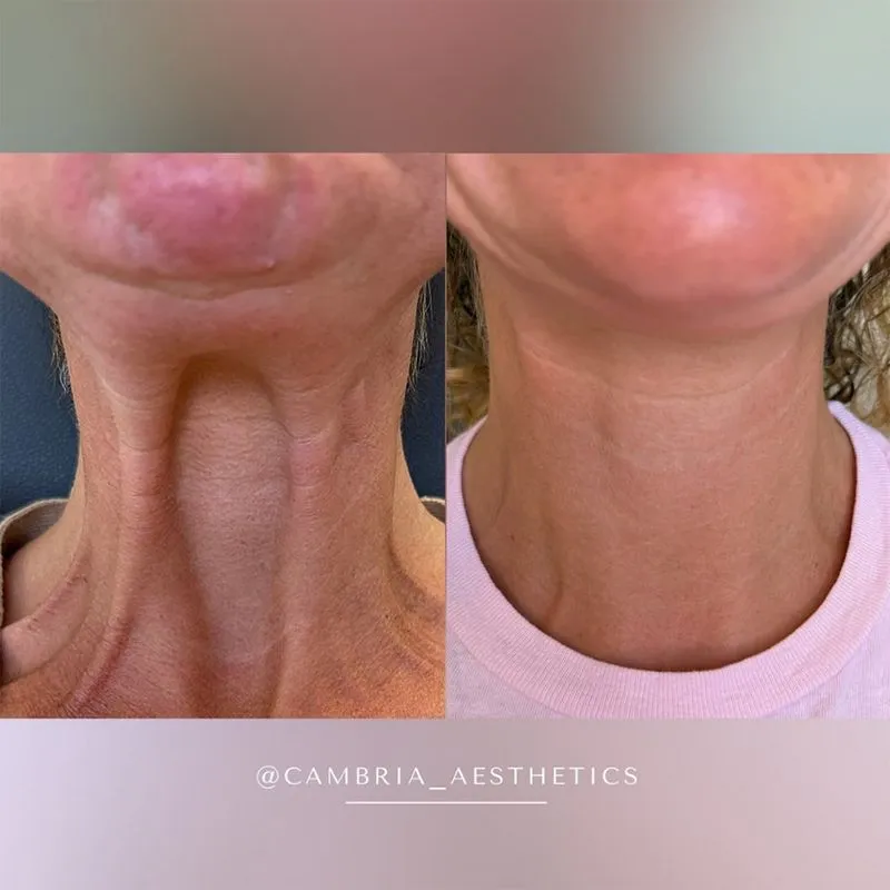botox for neck comparison