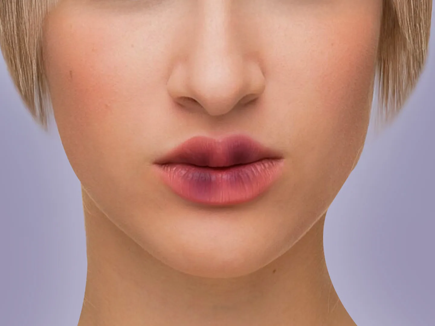 Lip Filler Bruising: Causes, Stages, and Fast Treatments