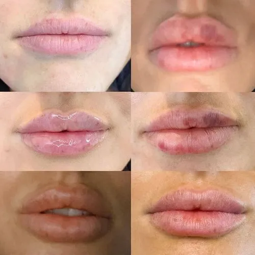 lip filler bruising