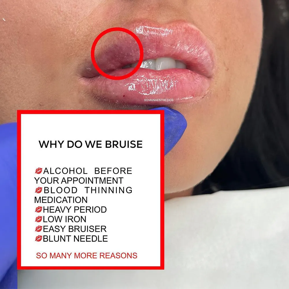 lip filler bruising causes