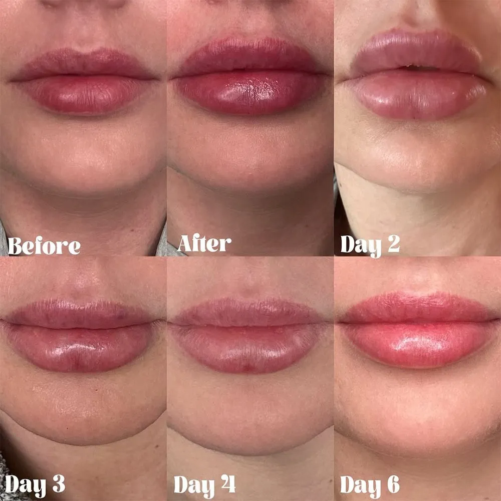 lip filler swelling stages