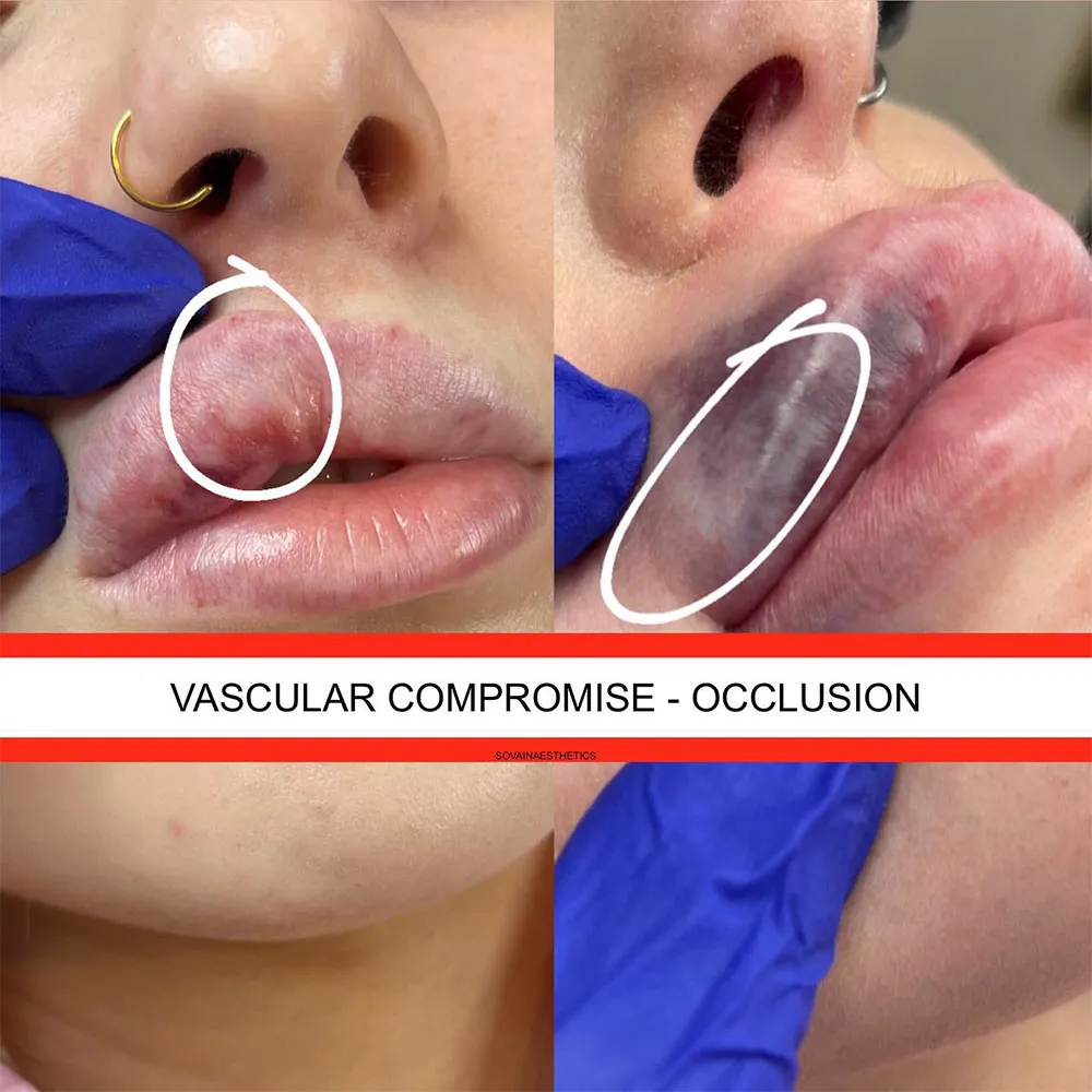 Vascular Occlusion after Lip Filler