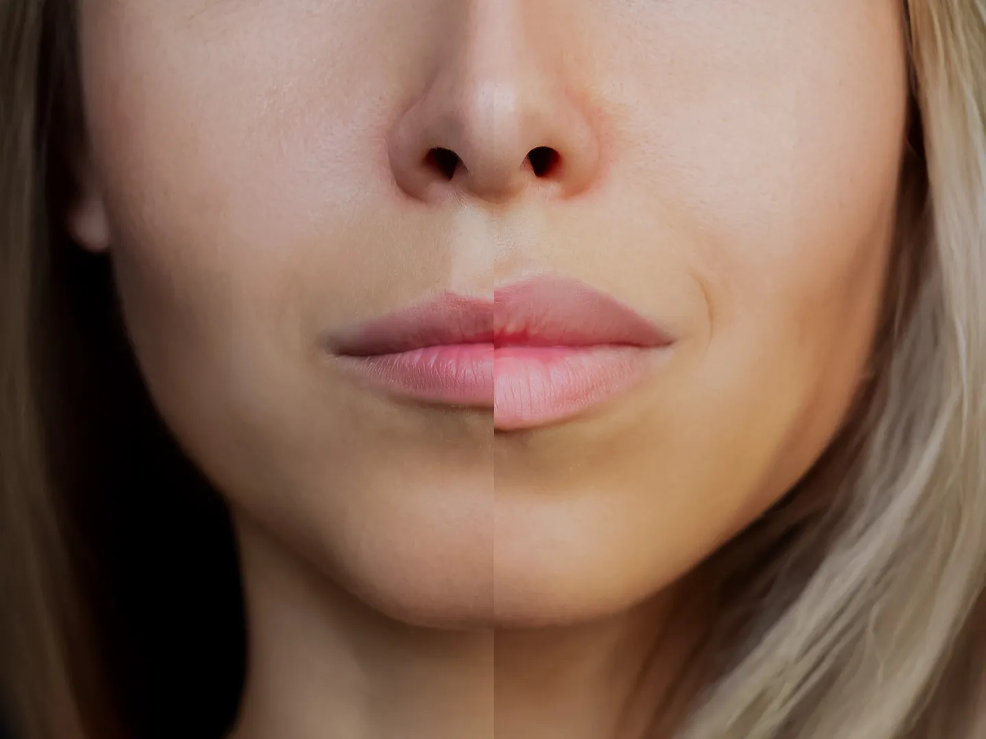 Lip Filler Before and After: How to Achieve Top Lip Enhancement Results